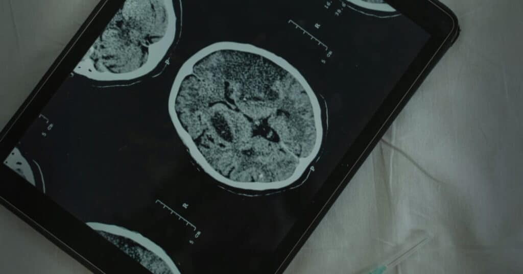 la epilepsia