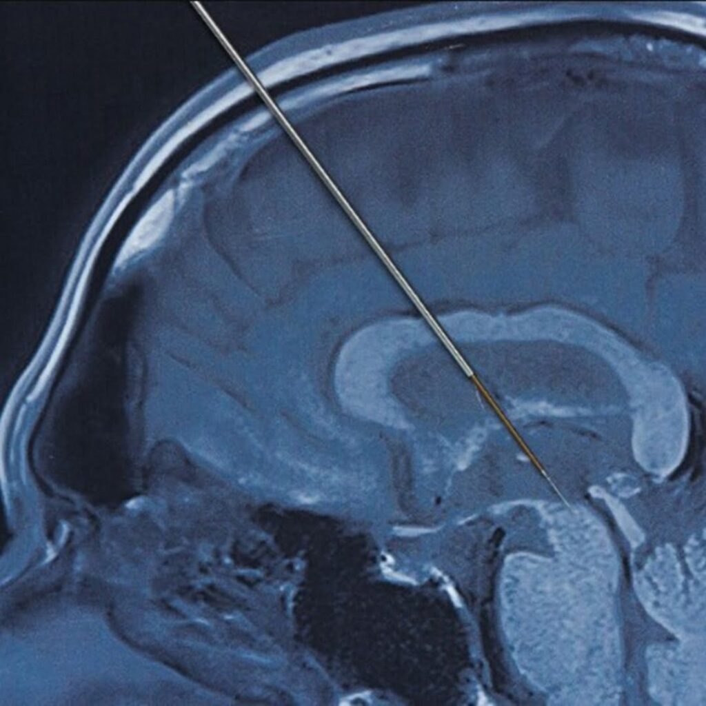 La epilepsia