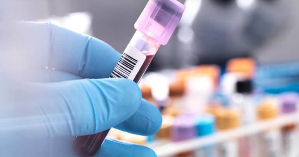 causa del lupus