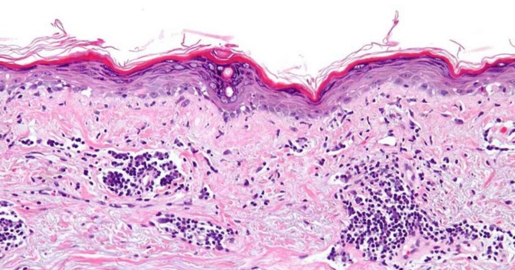 causa del lupus