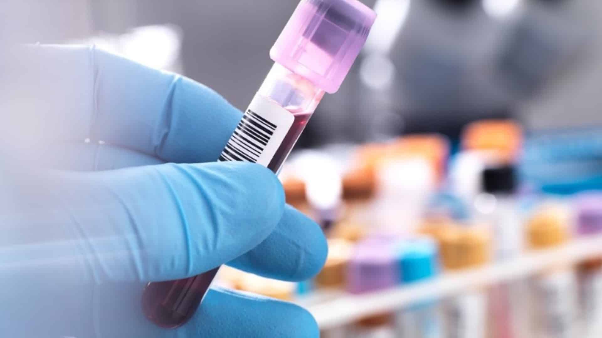 causa del lupus