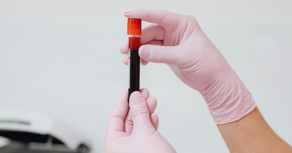 Análisis de sangre esclerosis múltiple