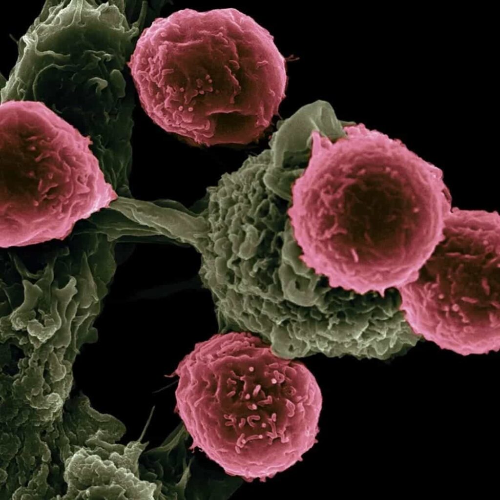 Cancer de pancreas 1 min