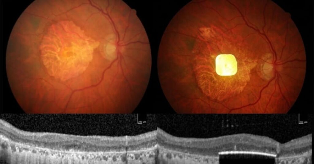 implante retinal con luz infrarroja