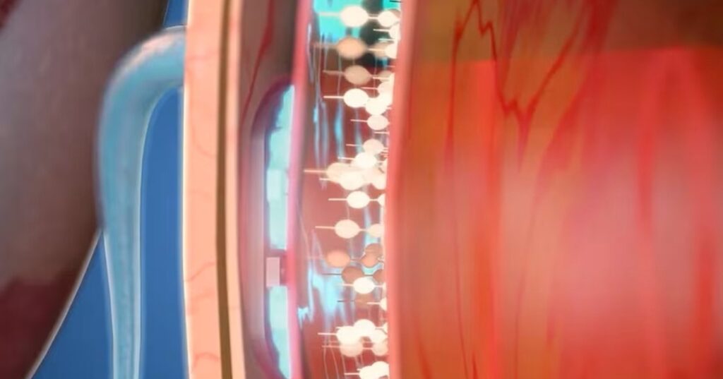 implante retinal con luz infrarroja