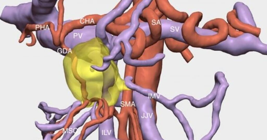 técnica pionera de doble bypass vascular