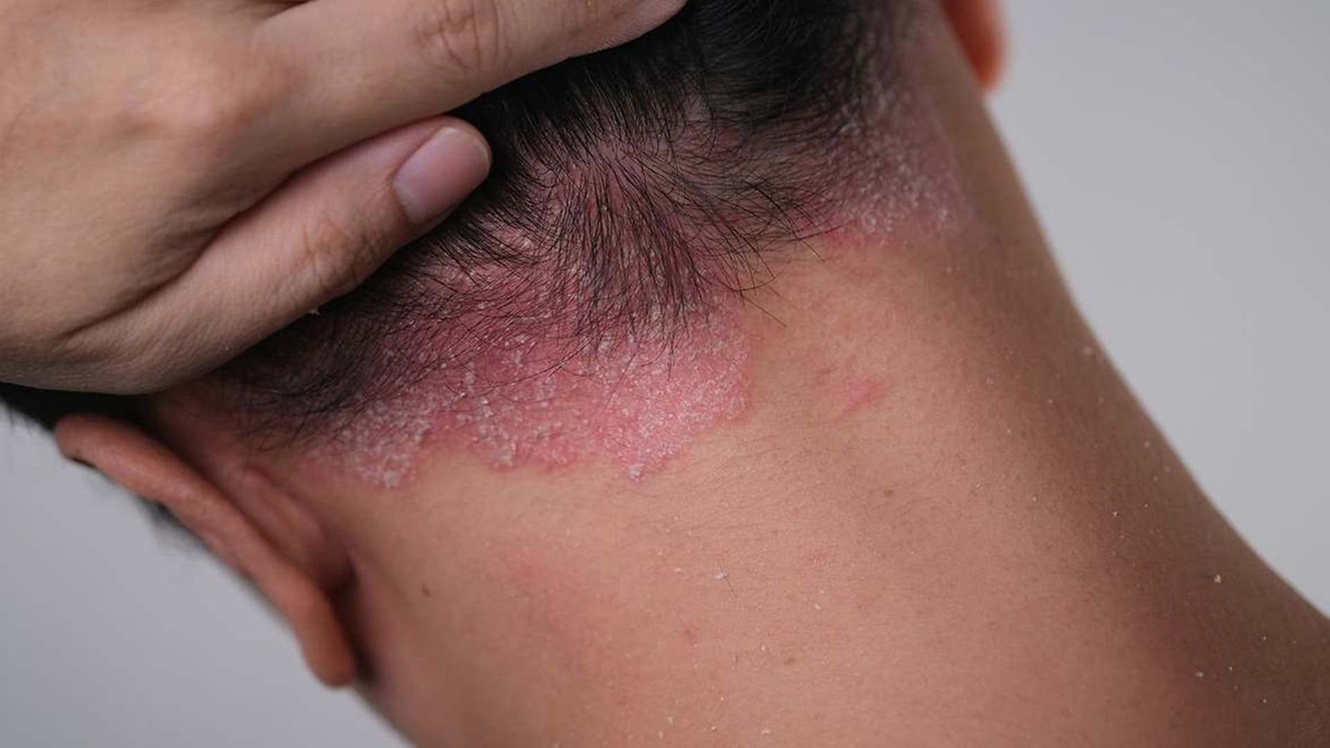 píldora de icotrokinra aprobada para tratar la psoriasis