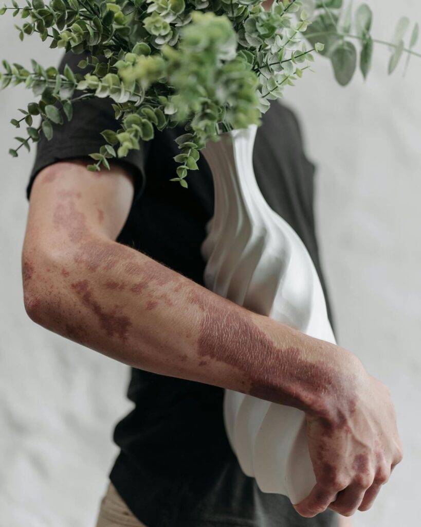 La píldora que le planta cara a los biológicos en psoriasis 5 píldora de icotrokinra aprobada para tratar la psoriasis
