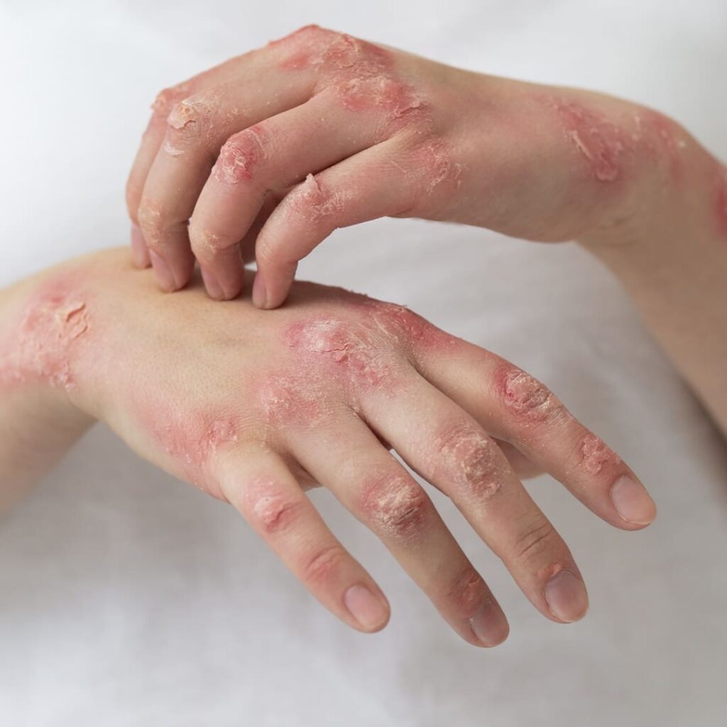 La píldora que le planta cara a los biológicos en psoriasis 3 píldora de icotrokinra aprobada para tratar la psoriasis