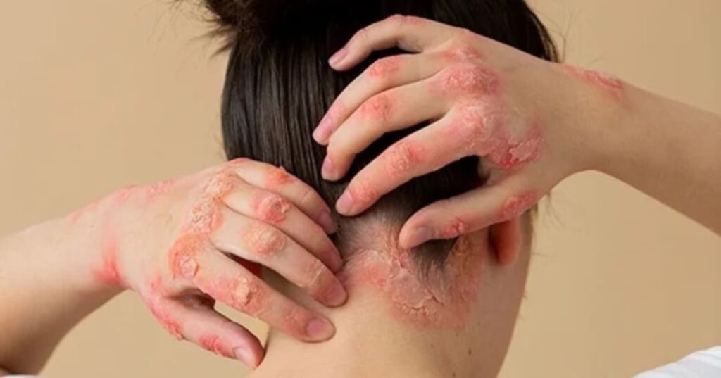 La píldora que le planta cara a los biológicos en psoriasis 2 píldora de icotrokinra aprobada para tratar la psoriasis