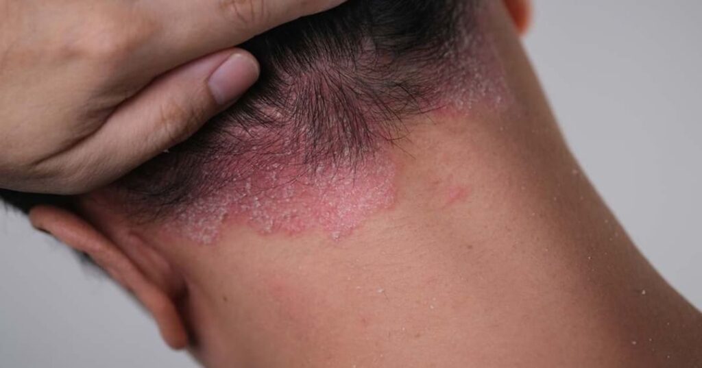La píldora que le planta cara a los biológicos en psoriasis 1 píldora de icotrokinra aprobada para tratar la psoriasis