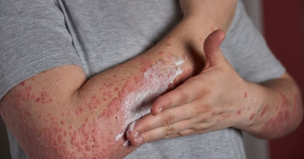 La píldora que le planta cara a los biológicos en psoriasis 4 píldora de icotrokinra aprobada para tratar la psoriasis