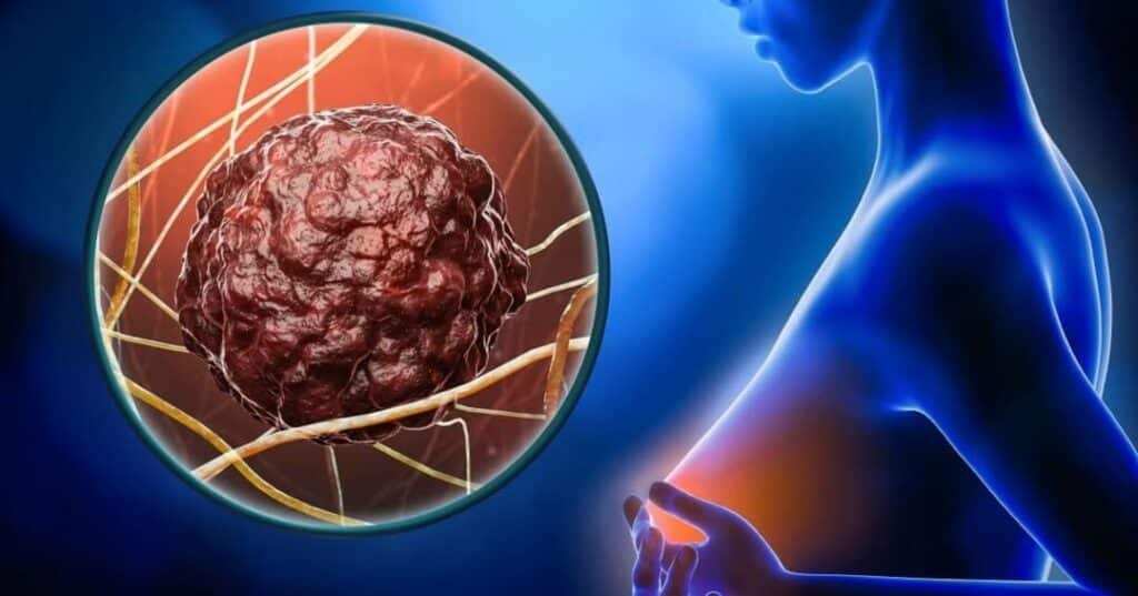 máquina MRI que congela tumores sin cirugía invasiva
