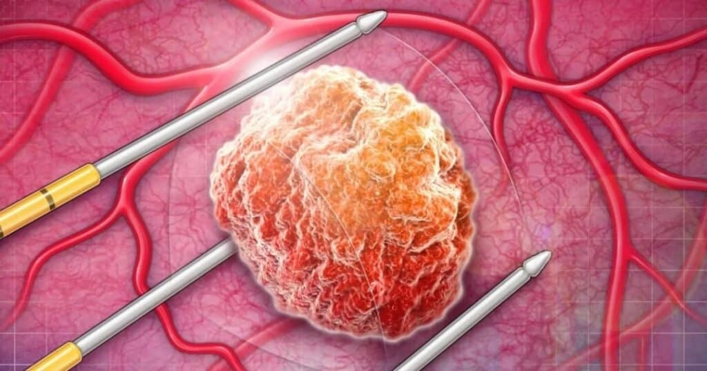 máquina MRI que congela tumores sin cirugía invasiva