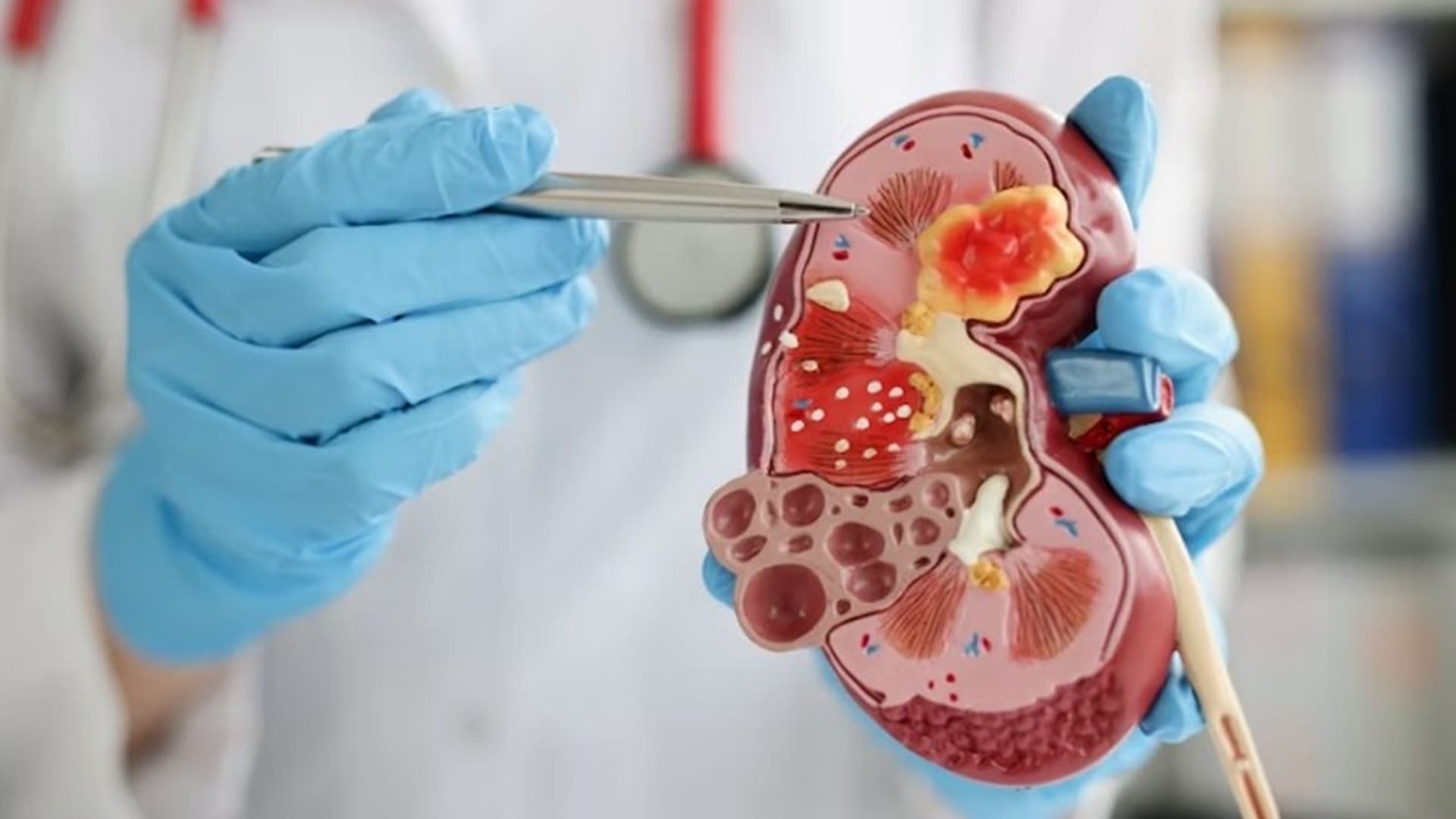 proteína IL-11 puede reducir la fibrosis y regenerar riñones