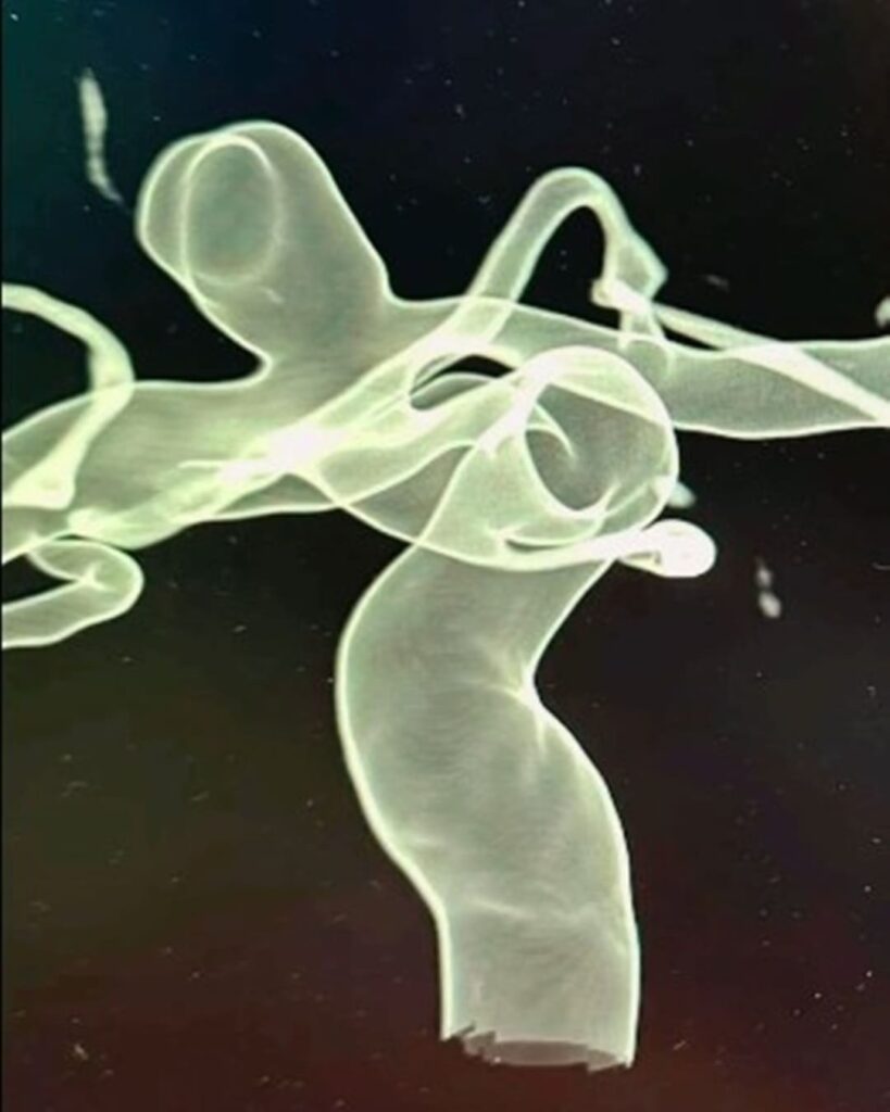 WEB: el implante que trata aneurismas sin abrir el cráneo 7 dispositivo WEB trata aneurismas cerebrales sin cirugía
