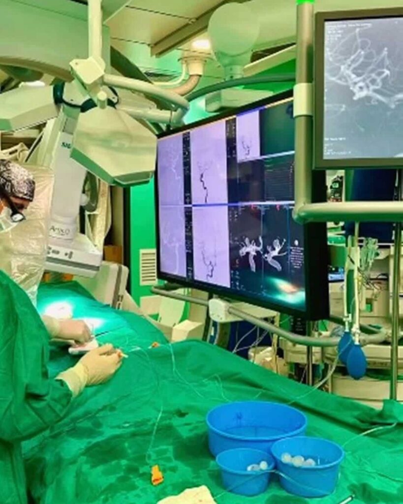 WEB: el implante que trata aneurismas sin abrir el cráneo 10 dispositivo WEB trata aneurismas cerebrales sin cirugía
