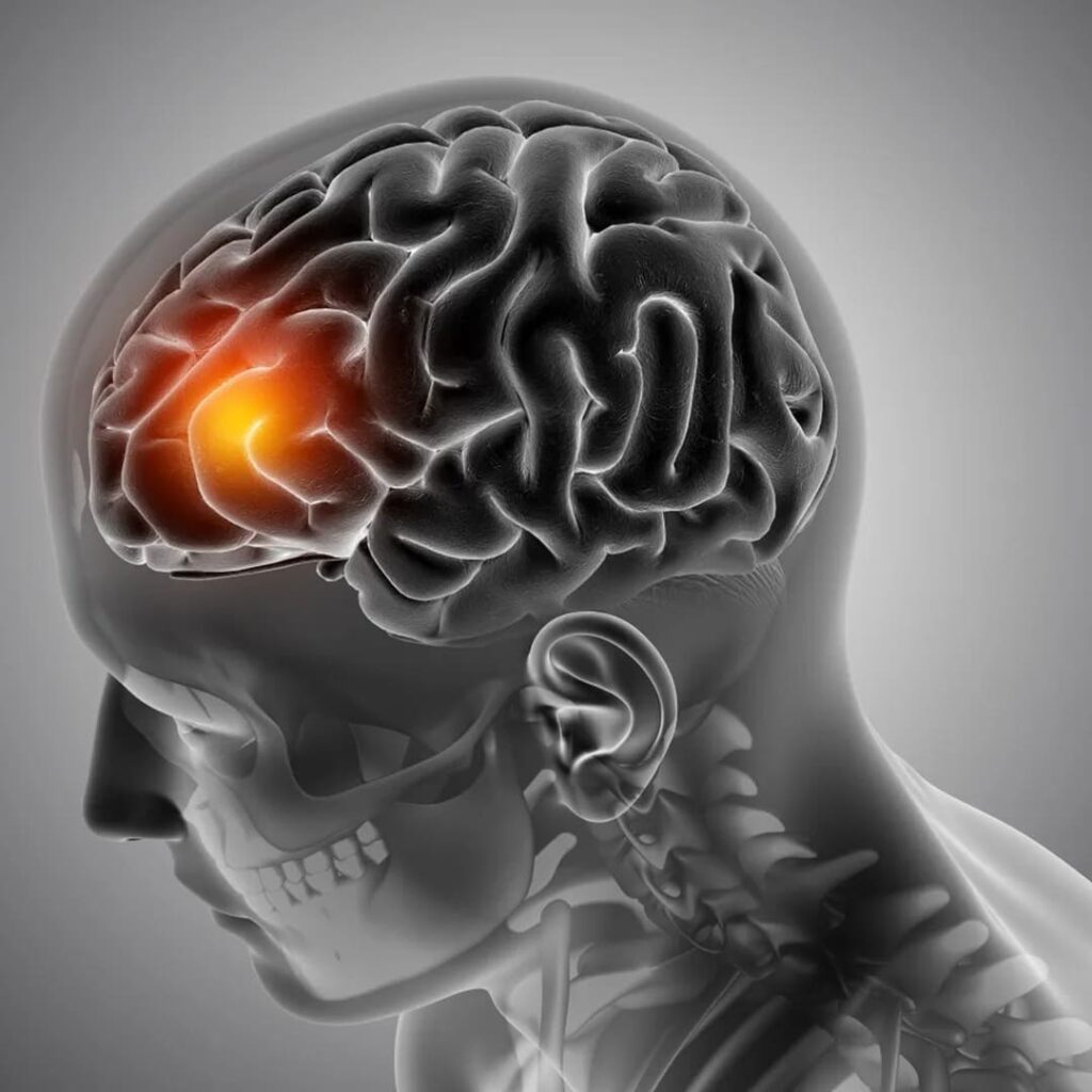 WEB: el implante que trata aneurismas sin abrir el cráneo 2 dispositivo WEB trata aneurismas cerebrales sin cirugía