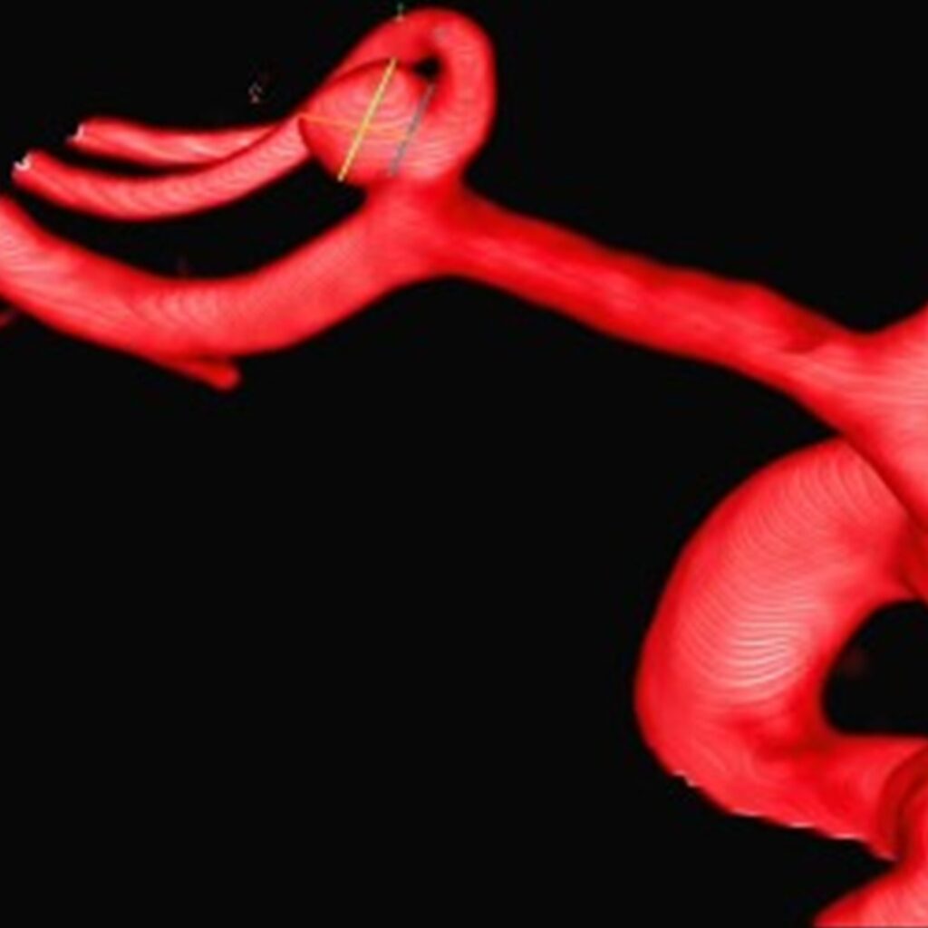 WEB: el implante que trata aneurismas sin abrir el cráneo 9 dispositivo WEB trata aneurismas cerebrales sin cirugía