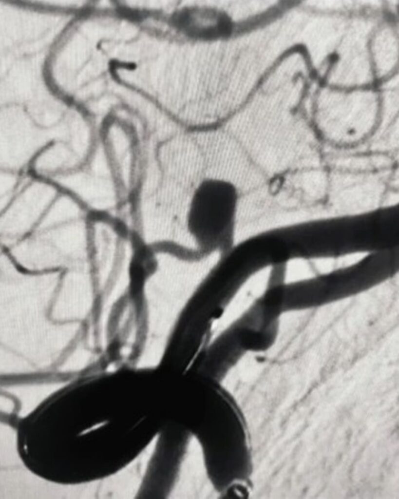 WEB: el implante que trata aneurismas sin abrir el cráneo 6 dispositivo WEB trata aneurismas cerebrales sin cirugía