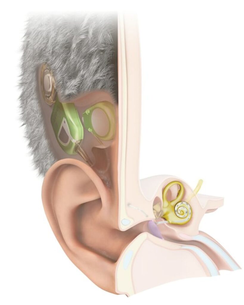 TICI UNICO: el implante coclear invisible que nunca se apaga 5 primer implante coclear invisible